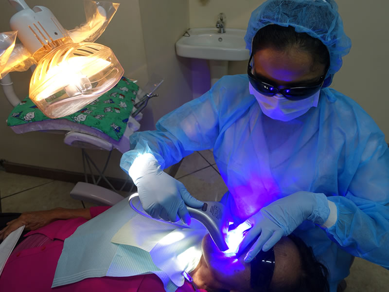 Teeth whitening using laser